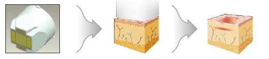 Korea Microneedle Bruch-Rf-Scharlachrot Maschinen-, großer Touch Screen